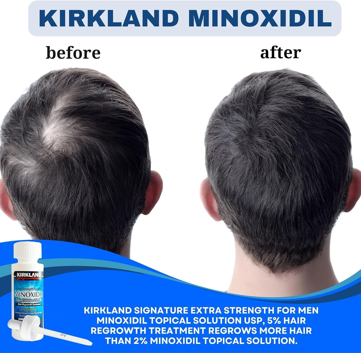 Kirkland Signature Minoxidil Extra Strength for Men Topical Solution USP 5 % - Hair Regrowth Treatment -  Unscented - 2 fl oz - Pack of 6 with Keychain